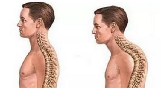 驼背的隐喻
